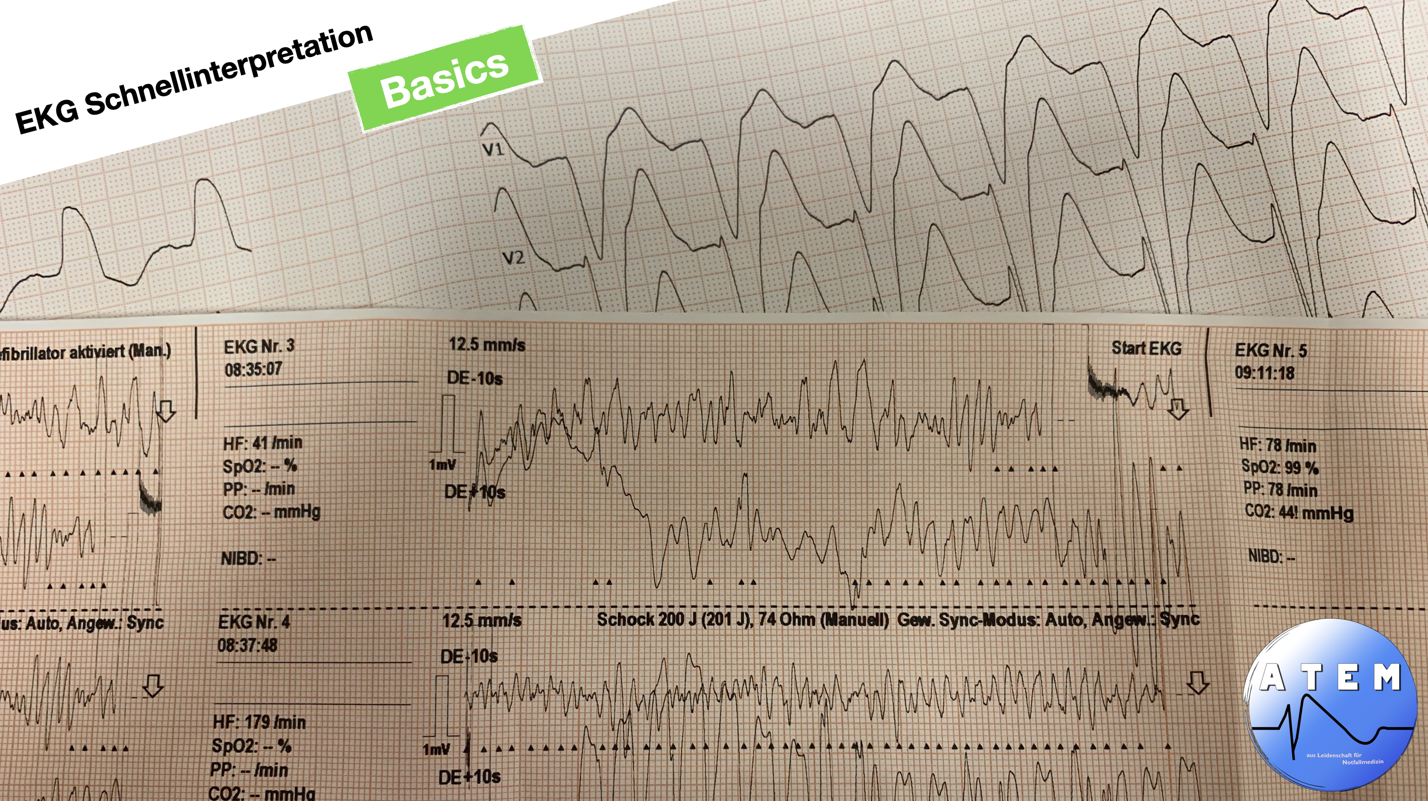 Geschützt: EKG Schnellinterpretation